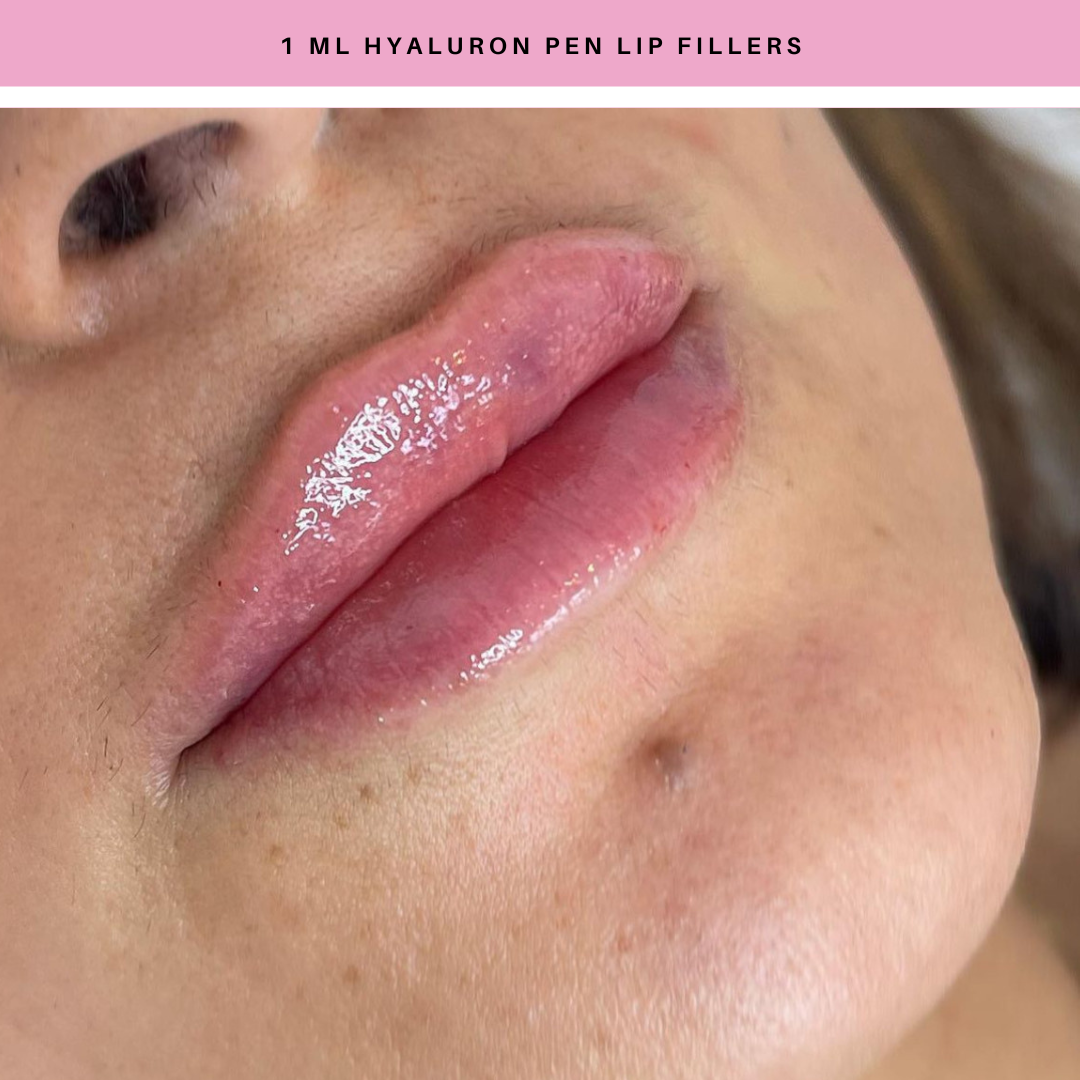 Lip Fillers