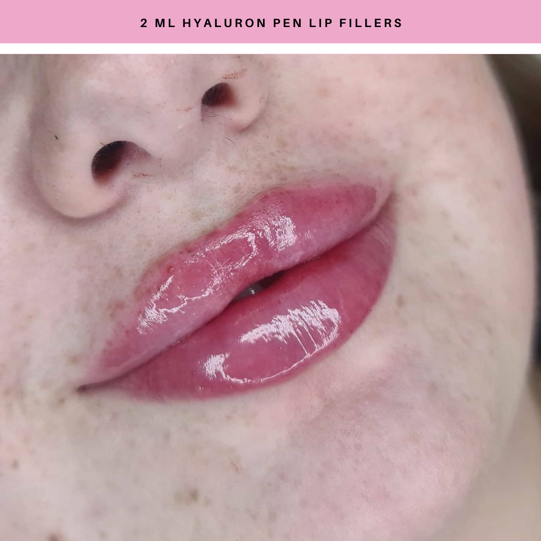 Lip Fillers