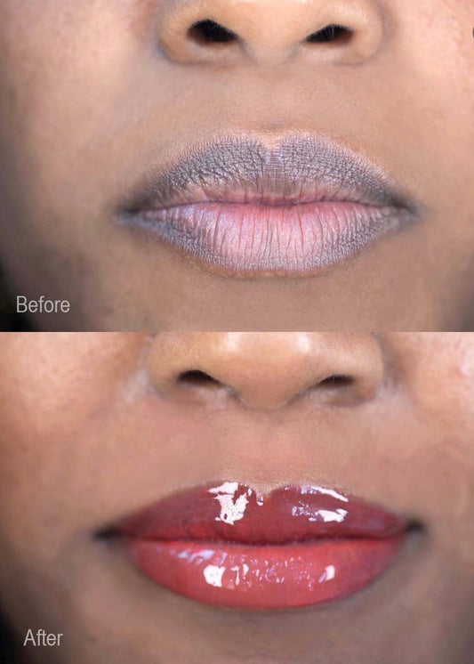 Dark Lip Correction/Lip Neutralization