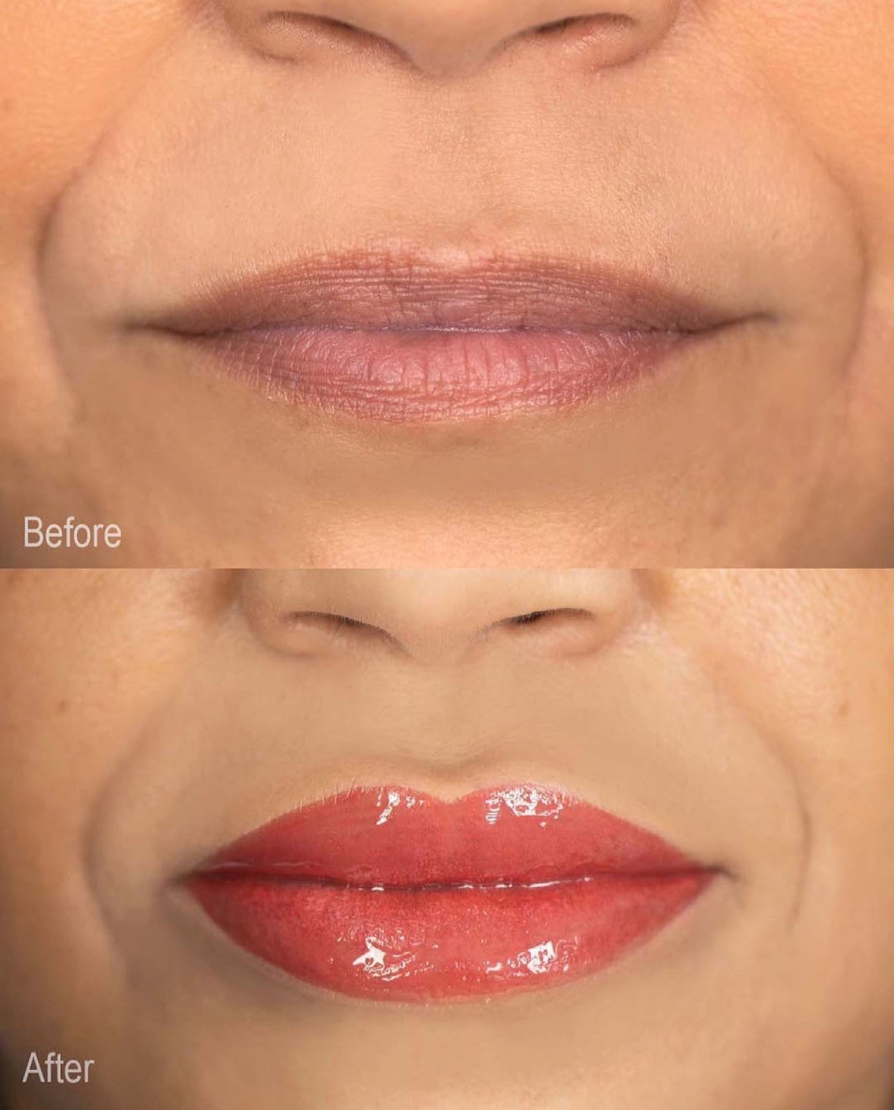 Dark Lip Correction/Lip Neutralization