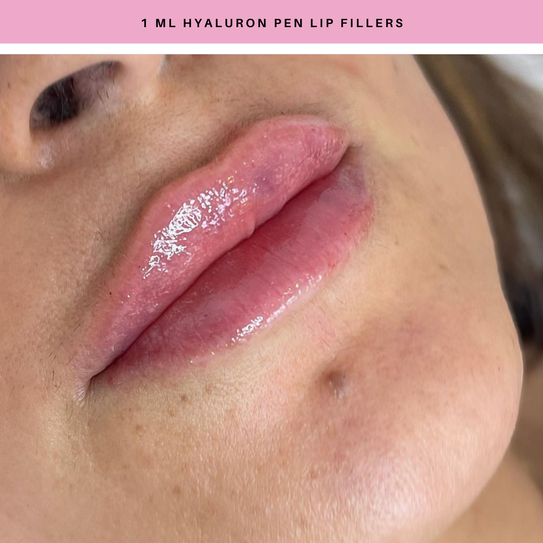 Hyaluron Pen Lip Fillers