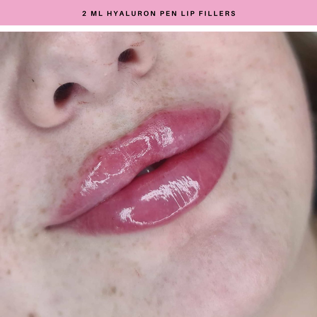 Hyaluron Pen Lip Fillers